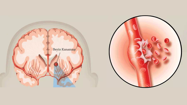 Beyin Kanaması